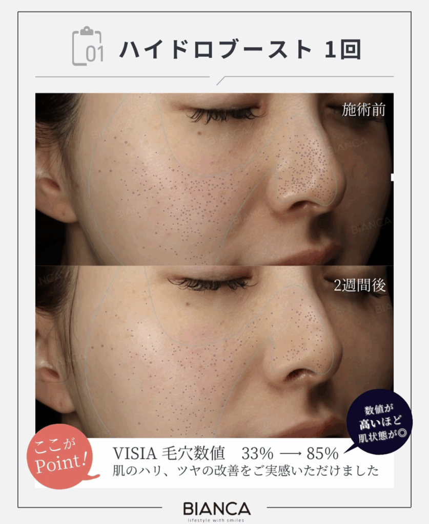 🌸【最新美肌治療】ハイドロブーストで肌を“再構築”🌸〜【Latest Skin Rejuvenation】Rebuild Your Skin with Hydro Boost〜