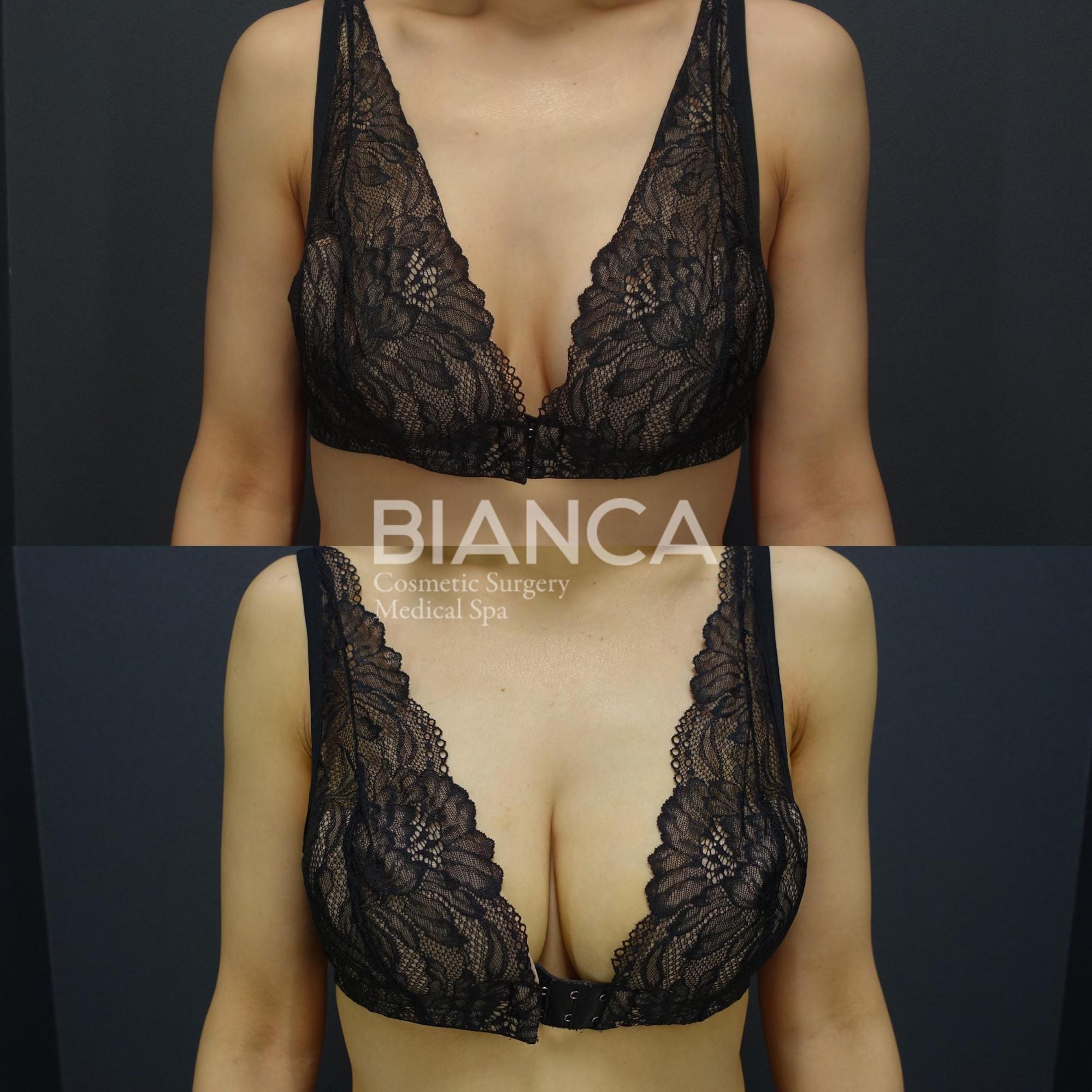 シリコンバック抜去・コンデンスリッチ脂肪注入