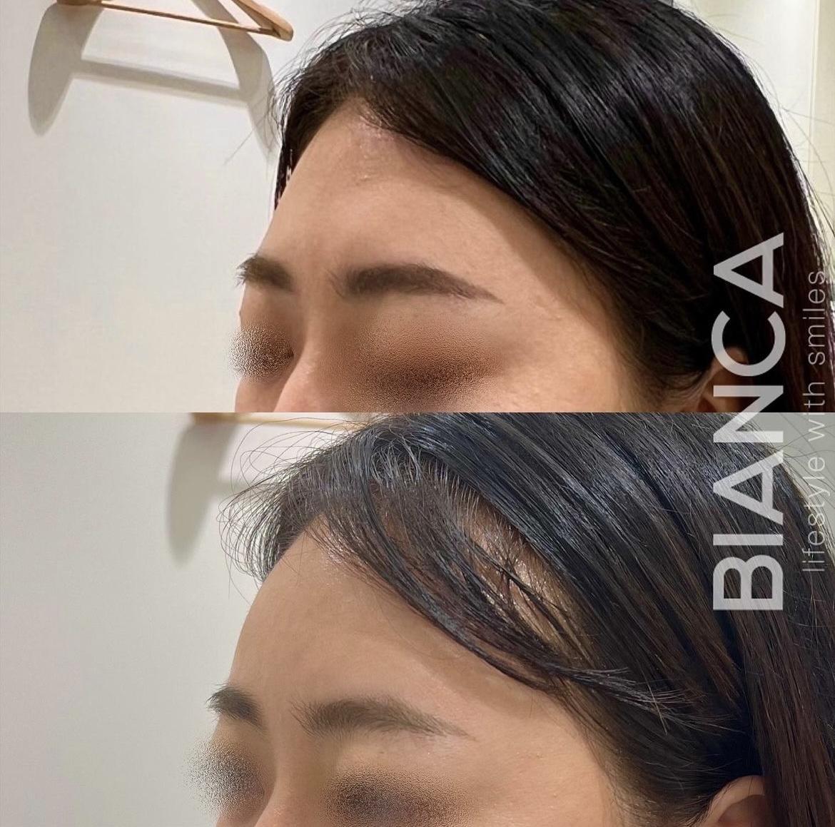 ヒアルロン酸注射