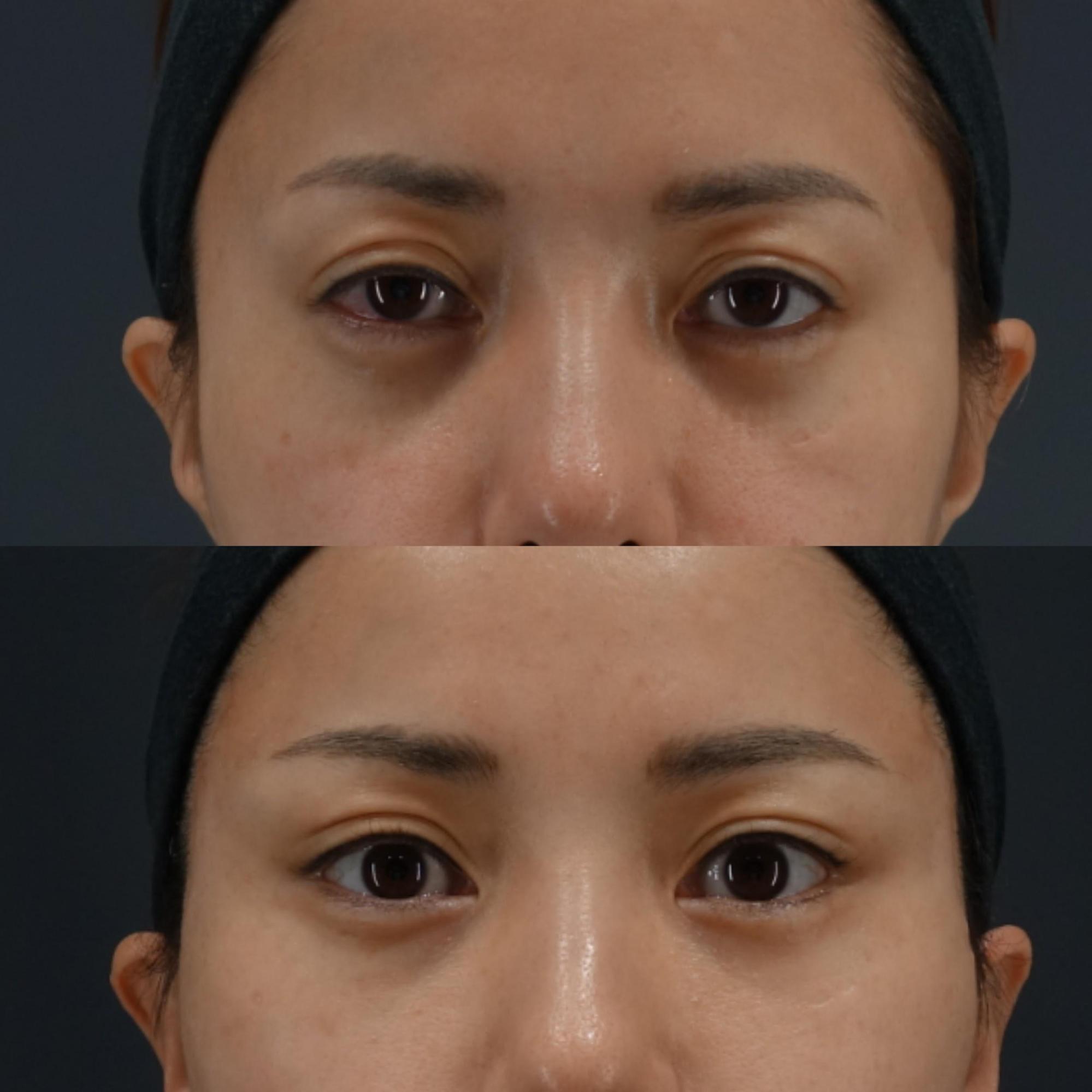 こめかみリフト・ディーププレーンフェイスリフト・プラスティマプラスティー