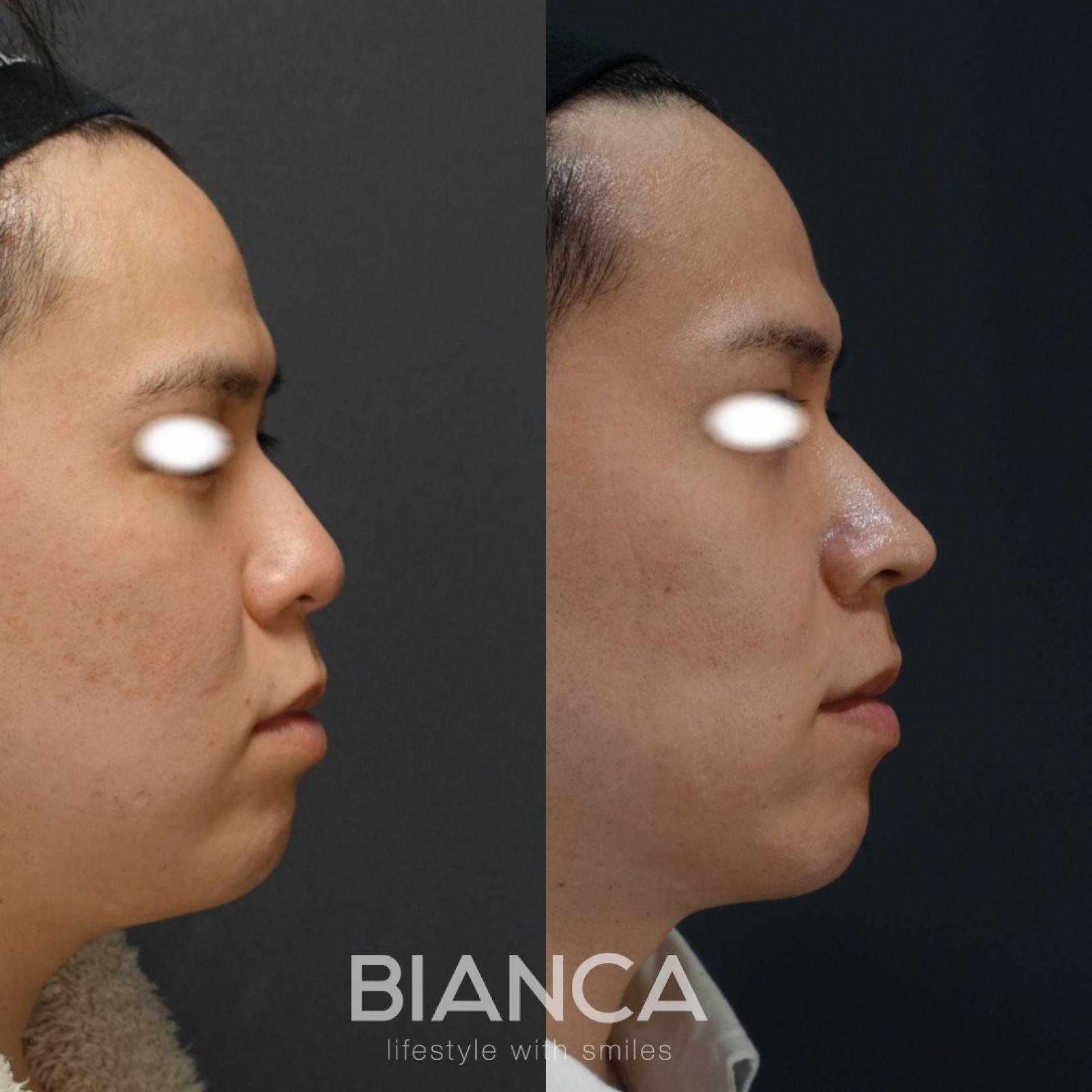 鼻骨骨切り・ハンプ切除・鼻中隔延長・鼻尖形成