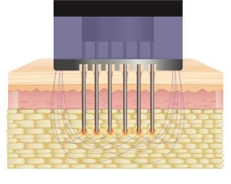 強力な熱エネルギーで皮膚たるみを改善！話題の”モフィウス8”とは？〜ポテンツァとの違いも解説〜