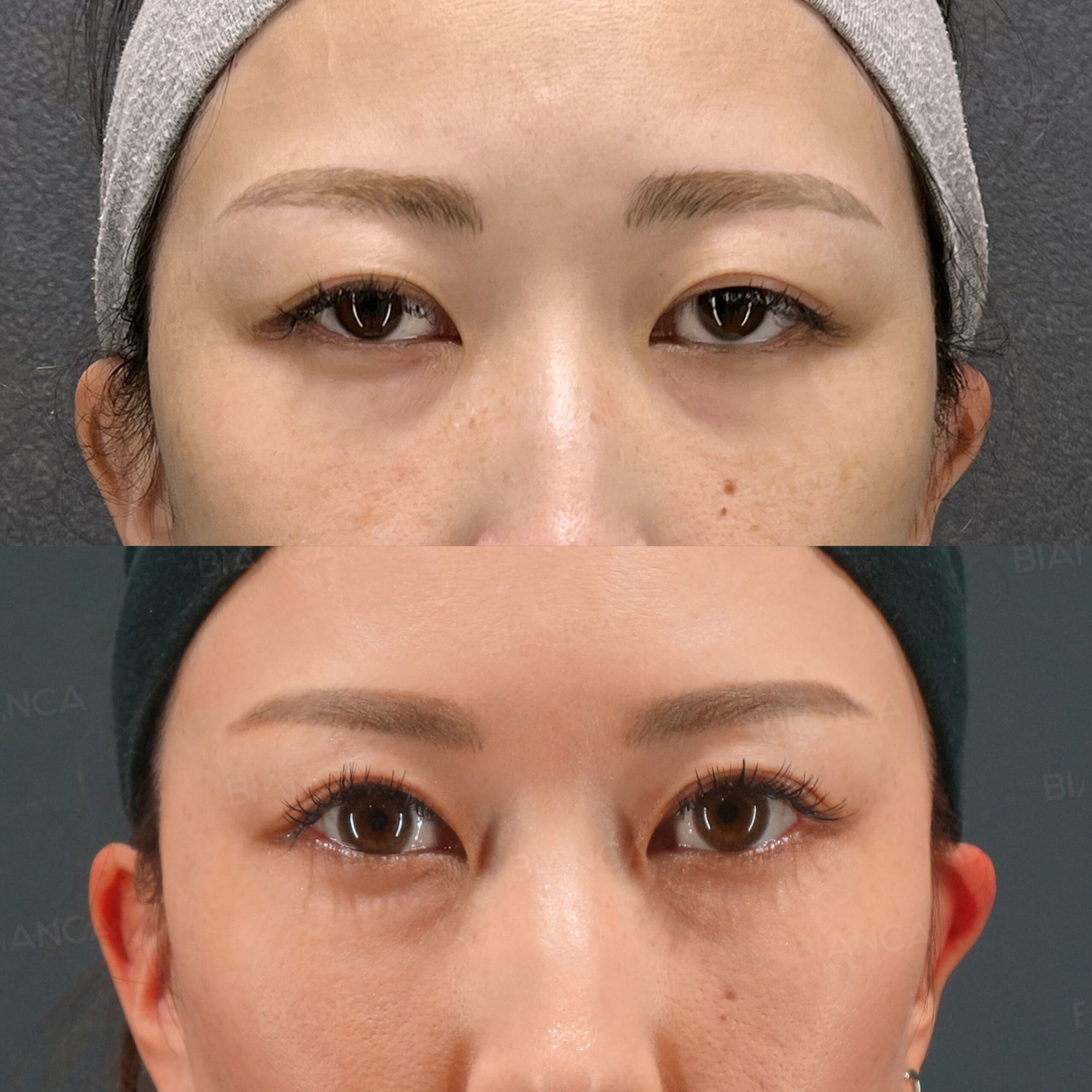 眼瞼下垂切開法