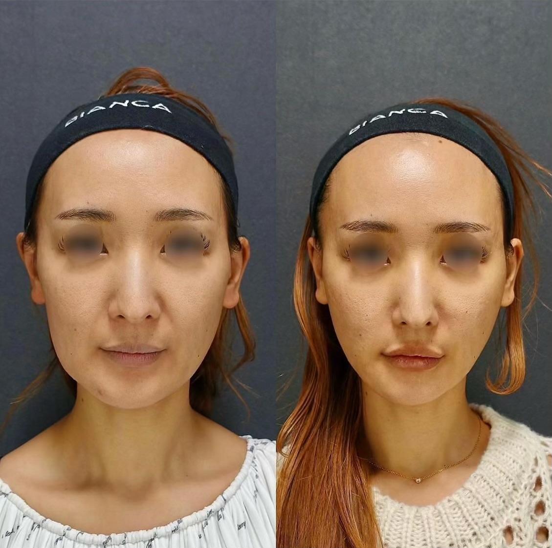 脂肪吸引・糸リフト