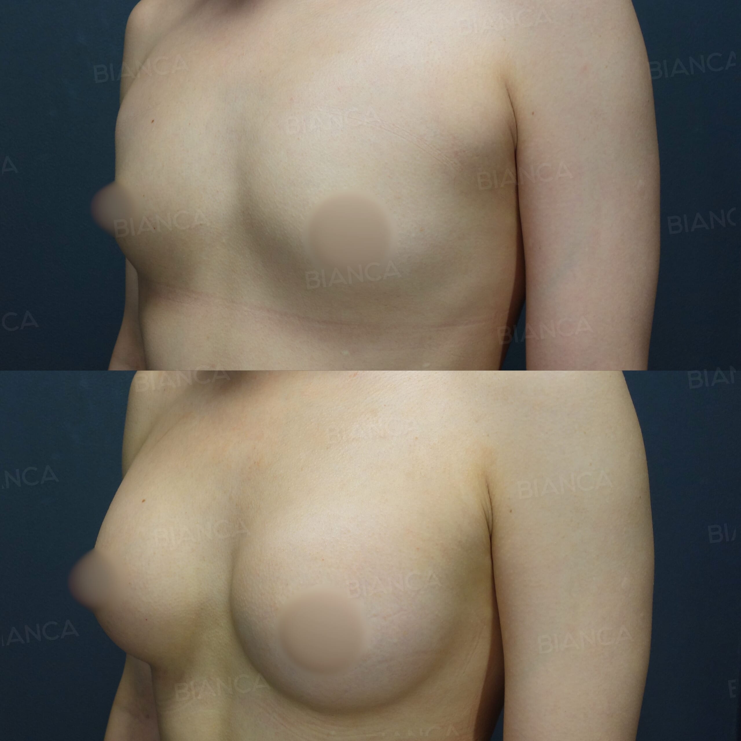 シリコンインプラント豊胸（シリコンバッグ豊胸）