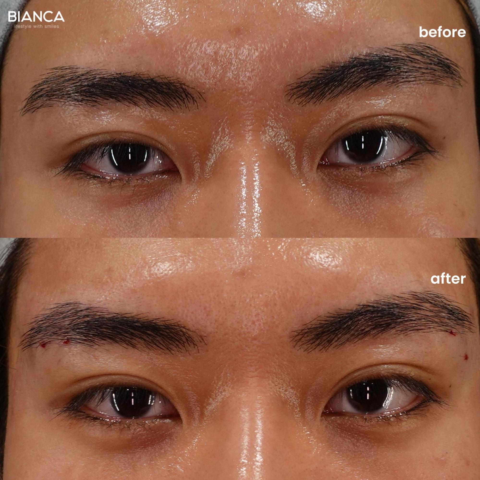 フォックスアイ（目元の糸リフト）