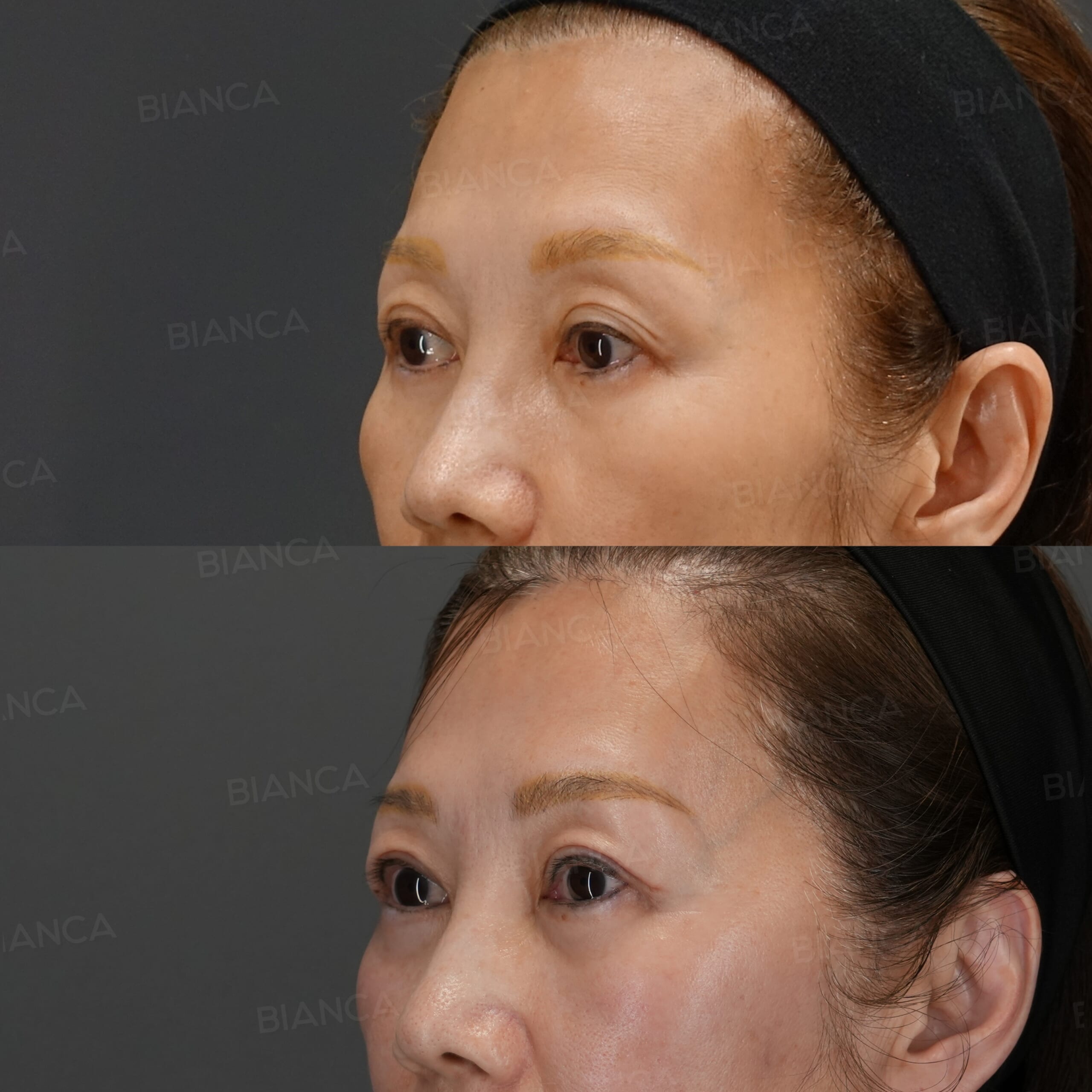 他院埋没後の修正 （埋没糸の抜糸・眼瞼下垂切開法）