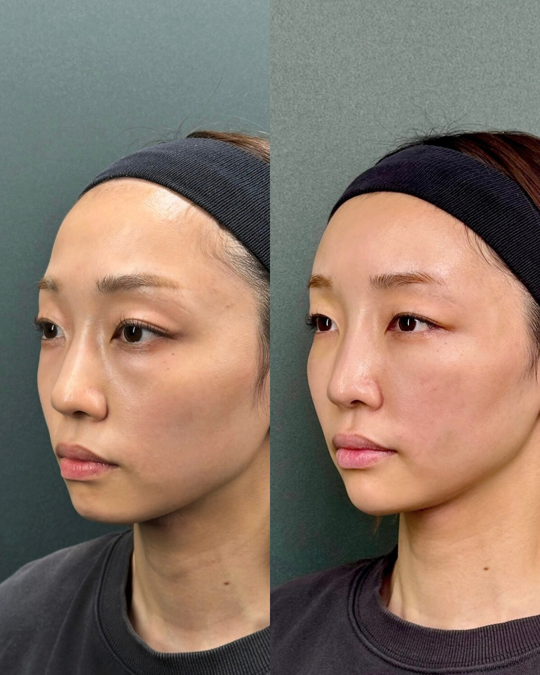 目の下のクマたるみ取り・脂肪注入