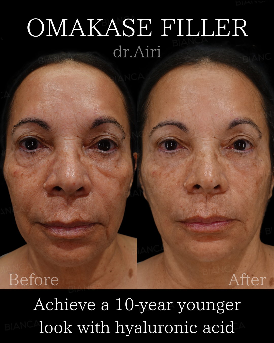 ヒアルロン酸注射・ベビーコラーゲン