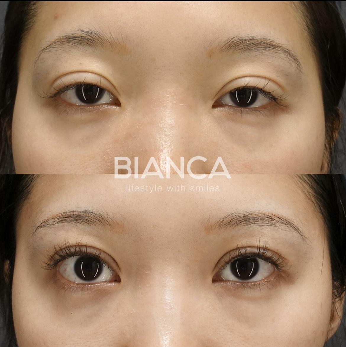 眼瞼下垂切開法