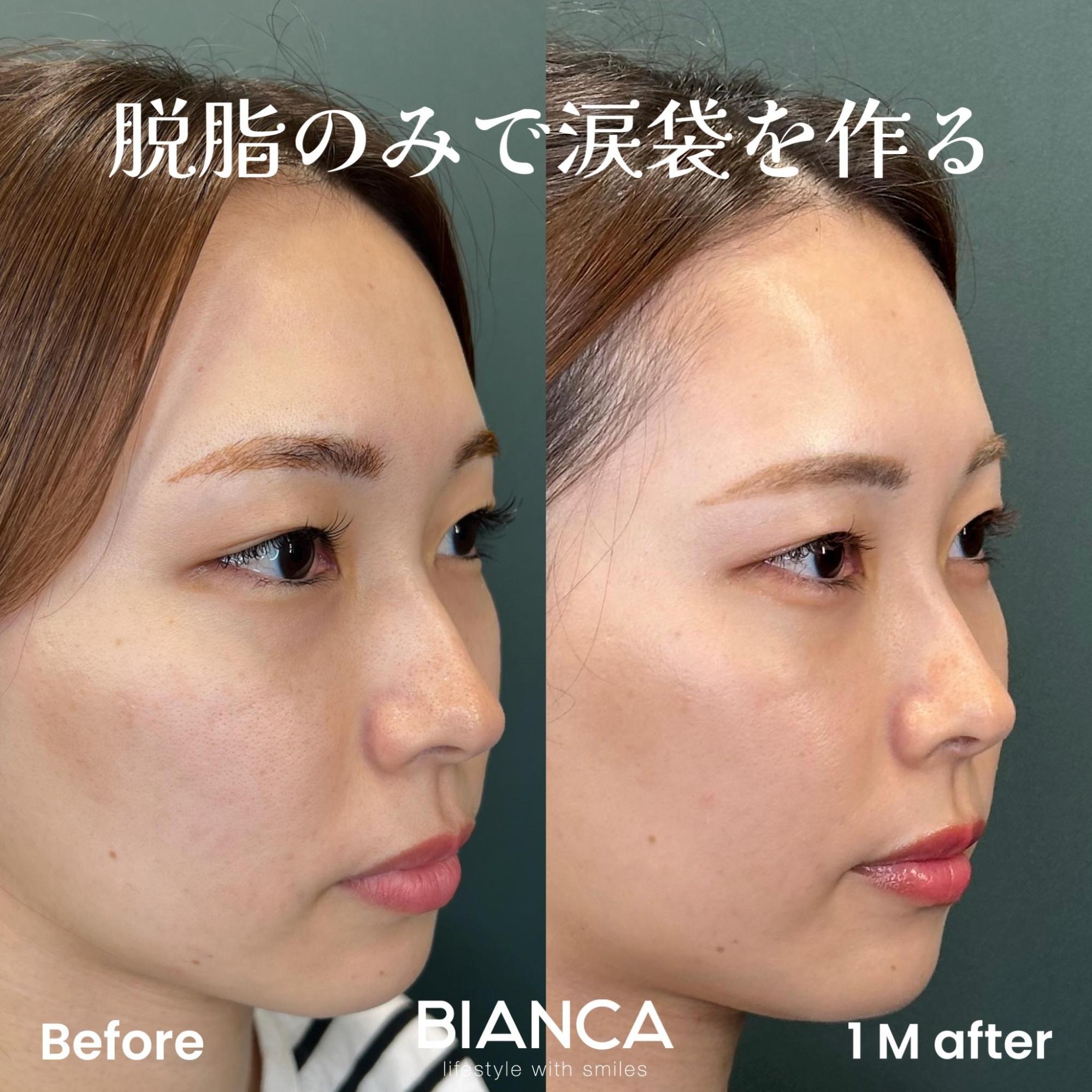 目の下のクマたるみ取り（結膜脱脂術）