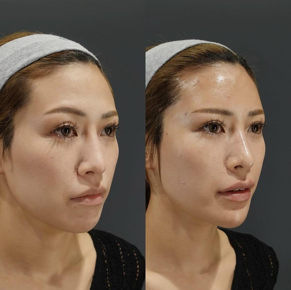 ヒアルロン酸注射