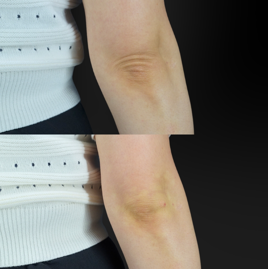 肘ヒアルロン酸注射