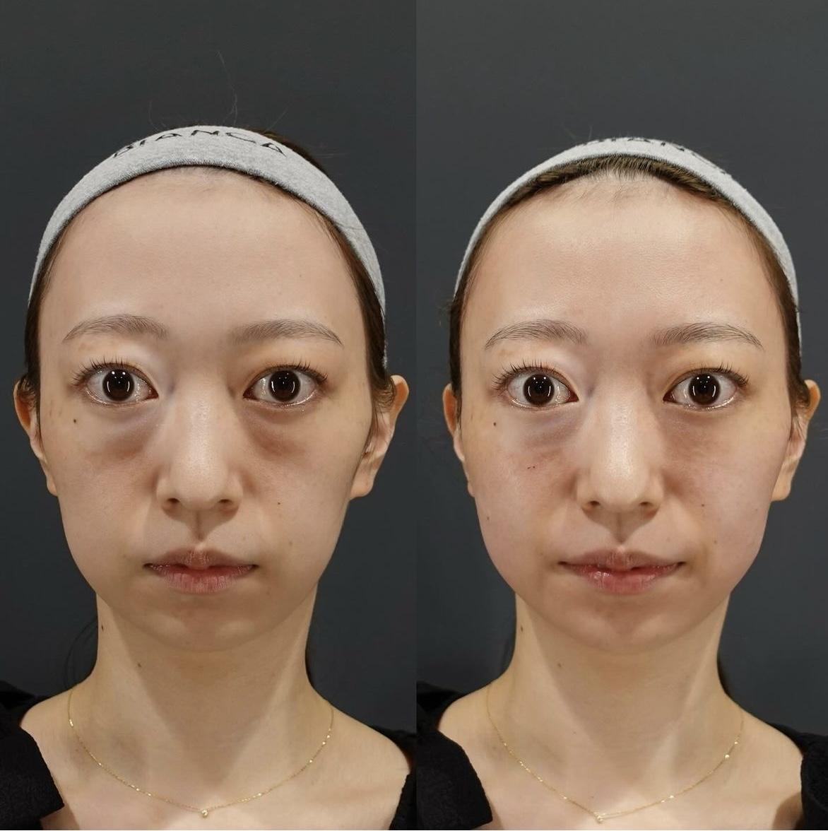 ヒアルロン酸注射