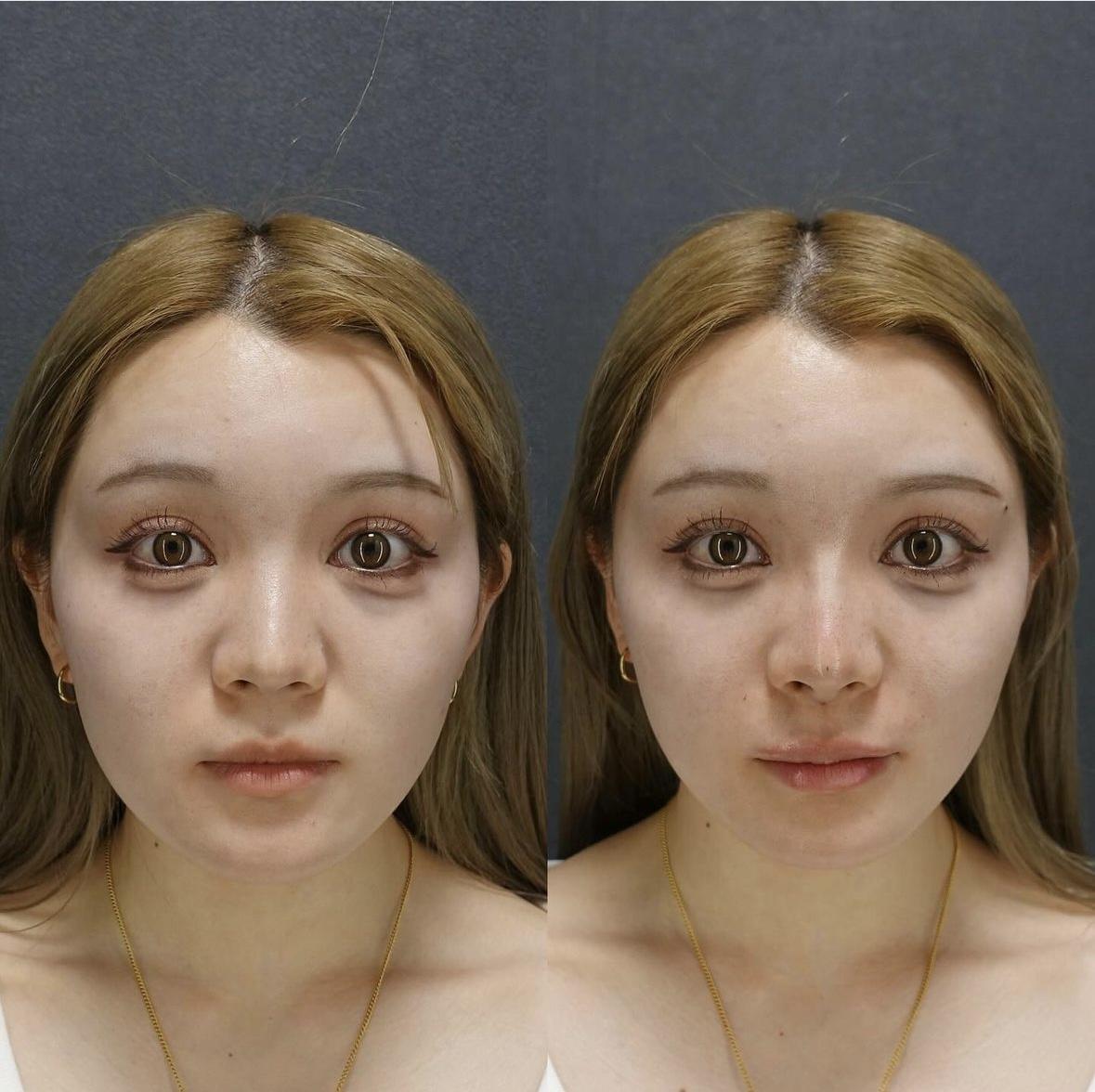 ヒアルロン酸注射