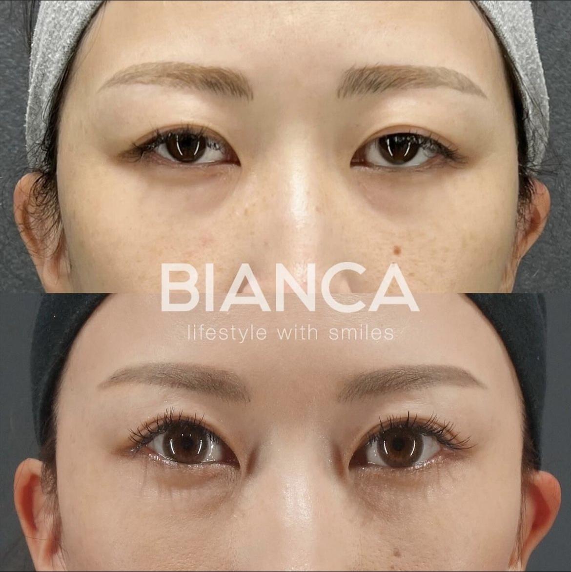 眼瞼下垂切開法