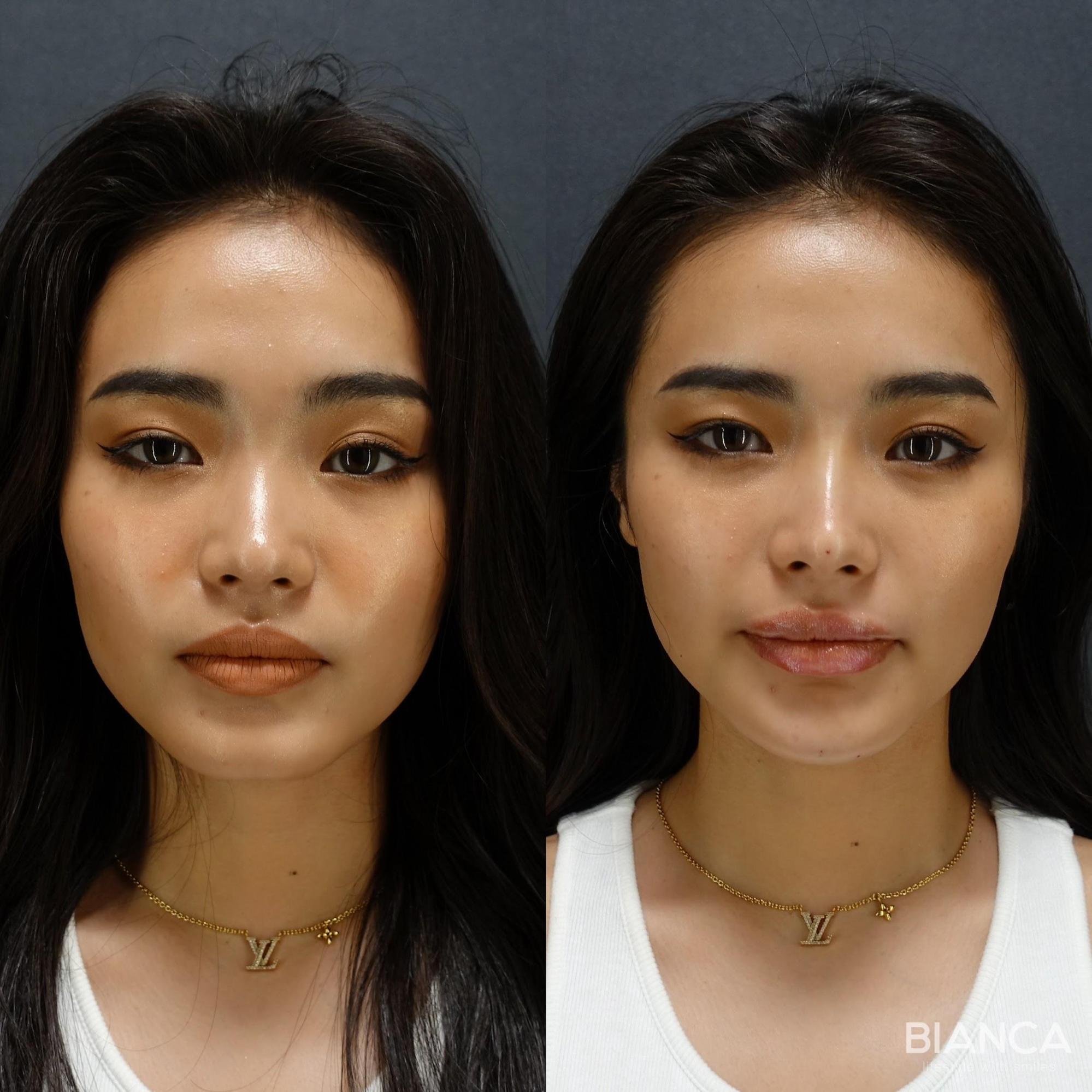 ヒアルロン酸注射