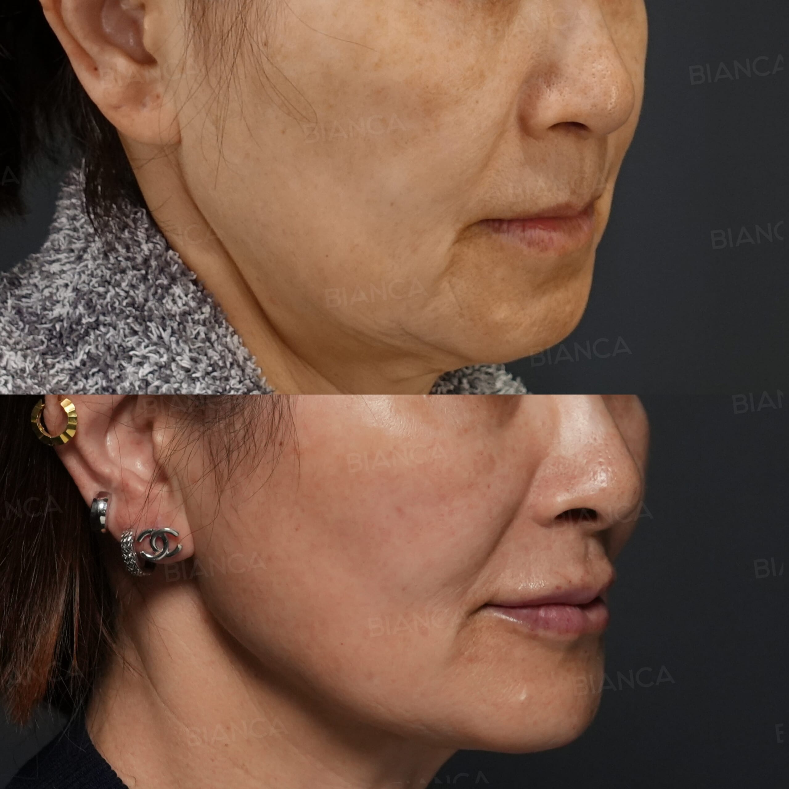 エンブレイスRF(頬+顎下)・ 脂肪吸引(頬+顎下)・ BIANCALIFT ・ヒアルロン酸(鼻+口唇+顎) 