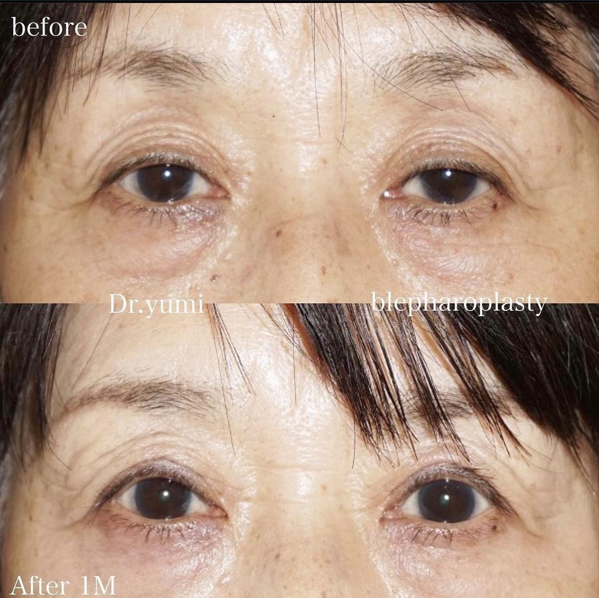 眼瞼下垂切開法