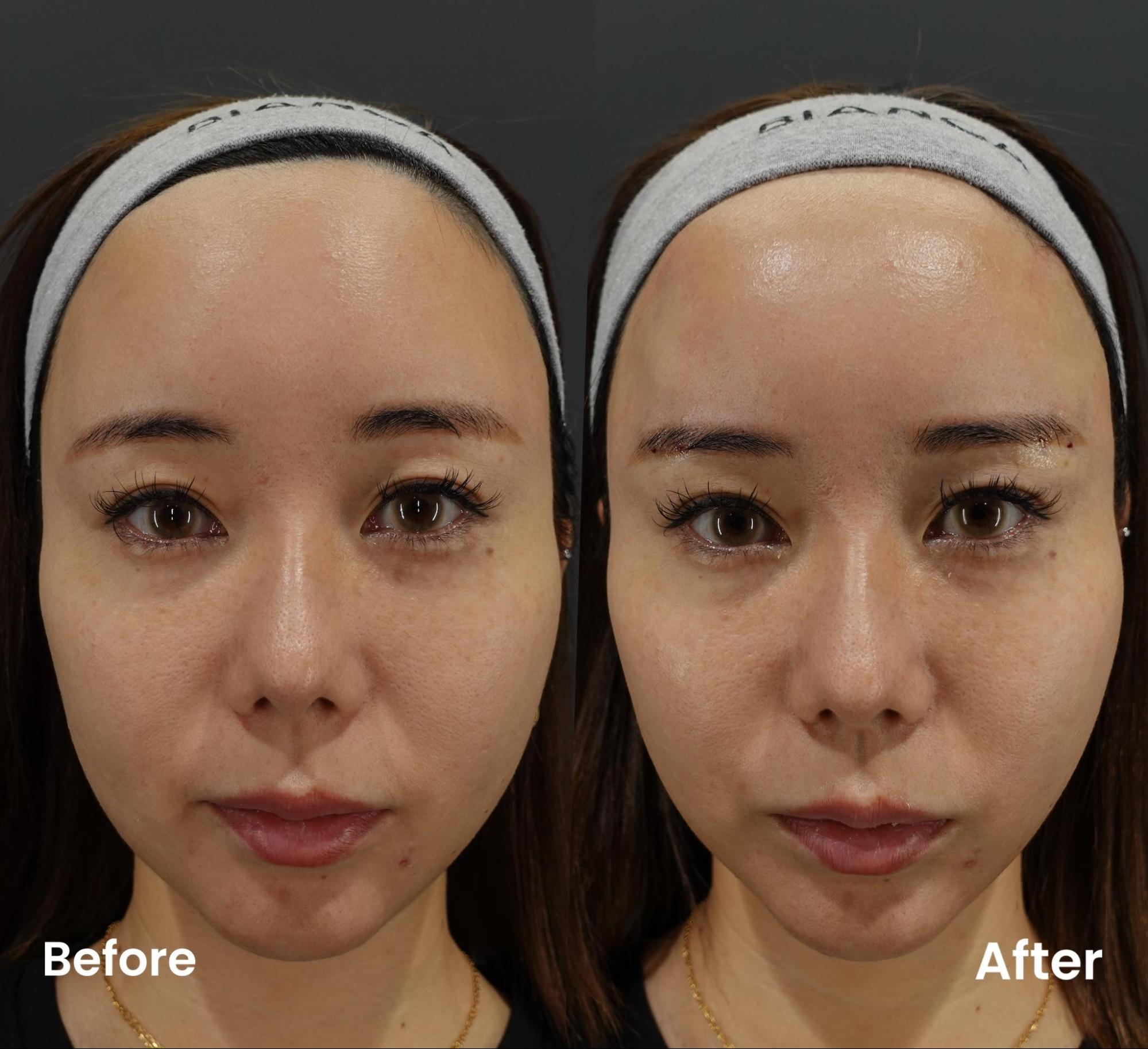 フォックスアイ（目元の糸リフト）