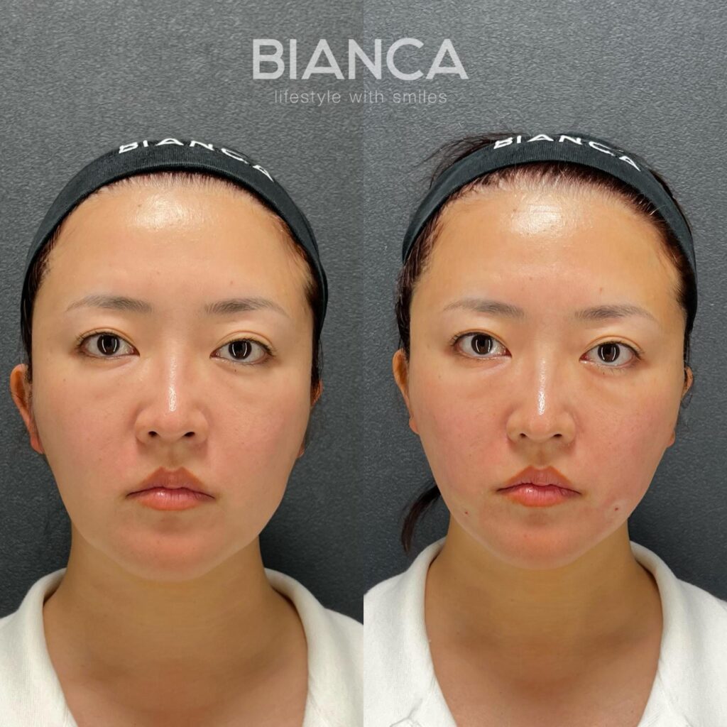 アルテミスリフト