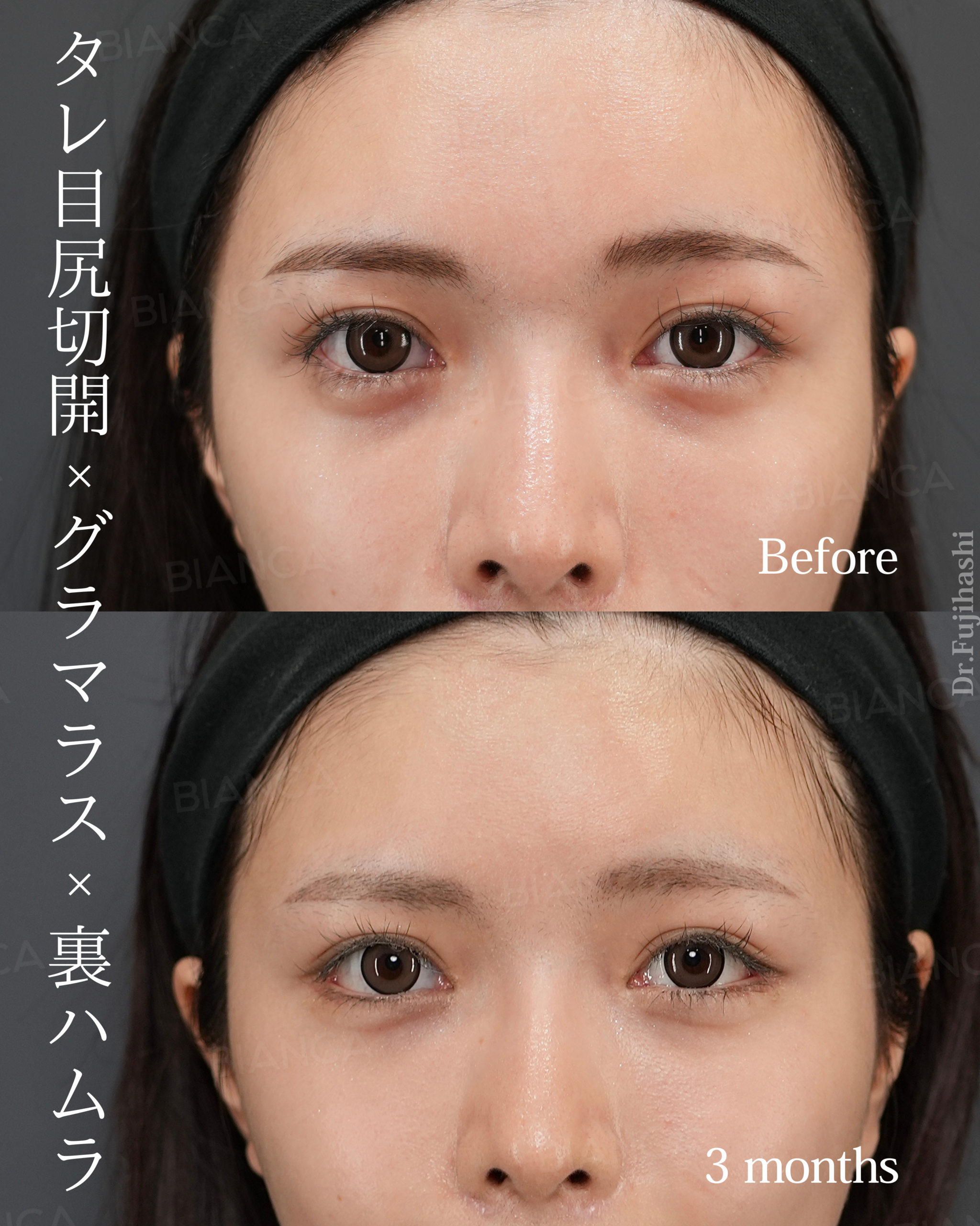 タレ目尻切開 ・グラマラスライン形成 ・裏ハムラ法