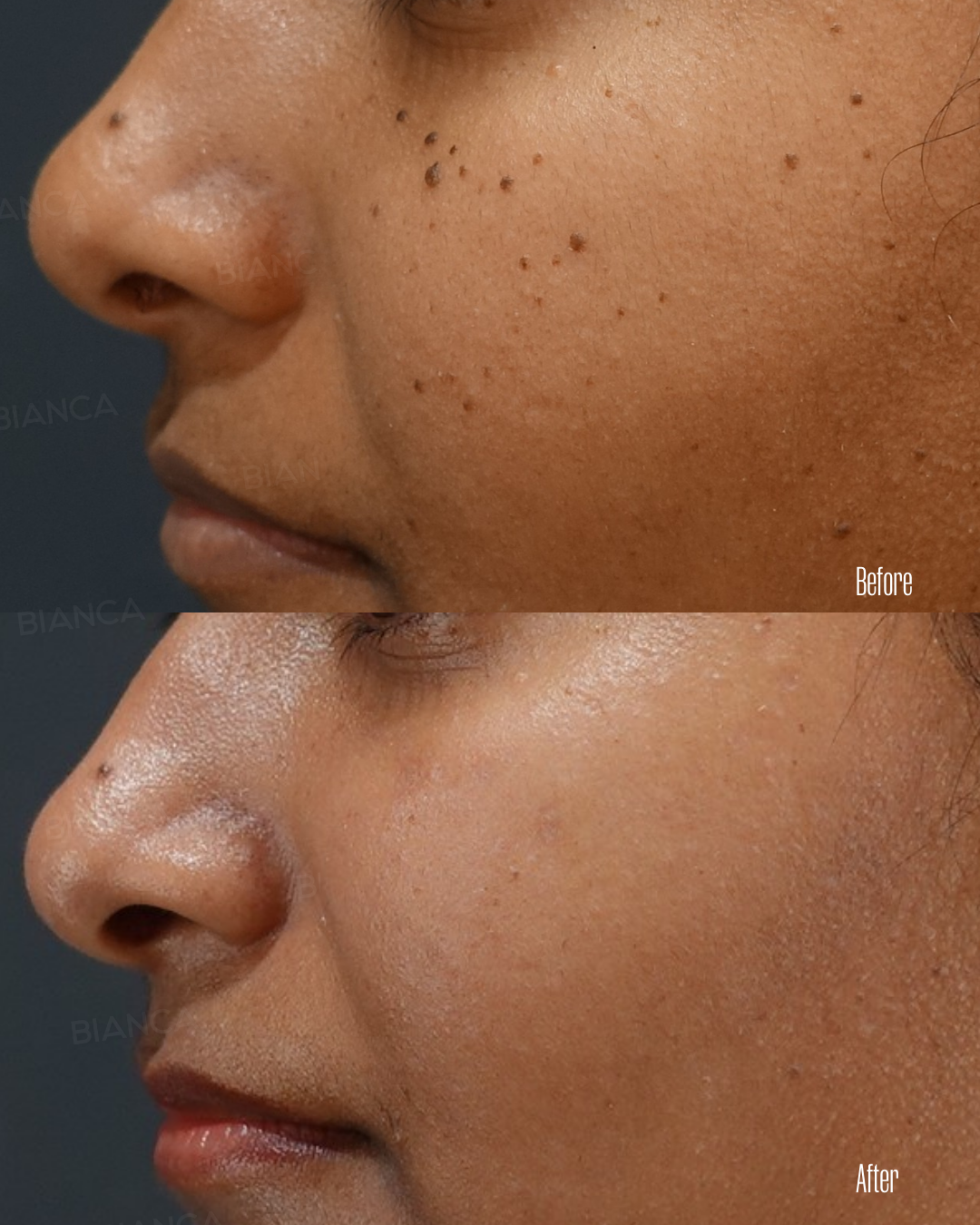 CO2レーザー（ホクロ・イボ取り）