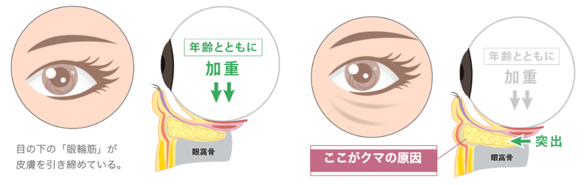 目の下クマ・たるみ取り（経結膜脱脂術）ビアンカ銀座｜日本を代表する美容健康再生医療のクリニック
