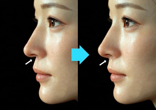 鼻柱下降術とは？「鼻柱下降術」と「鼻中隔延長」の違い｜銀座・表参道にあるBIANCA CLINIC ビアンカクリニック｜美容外科・美容皮膚科・再生医療・美容婦人科・美容内科