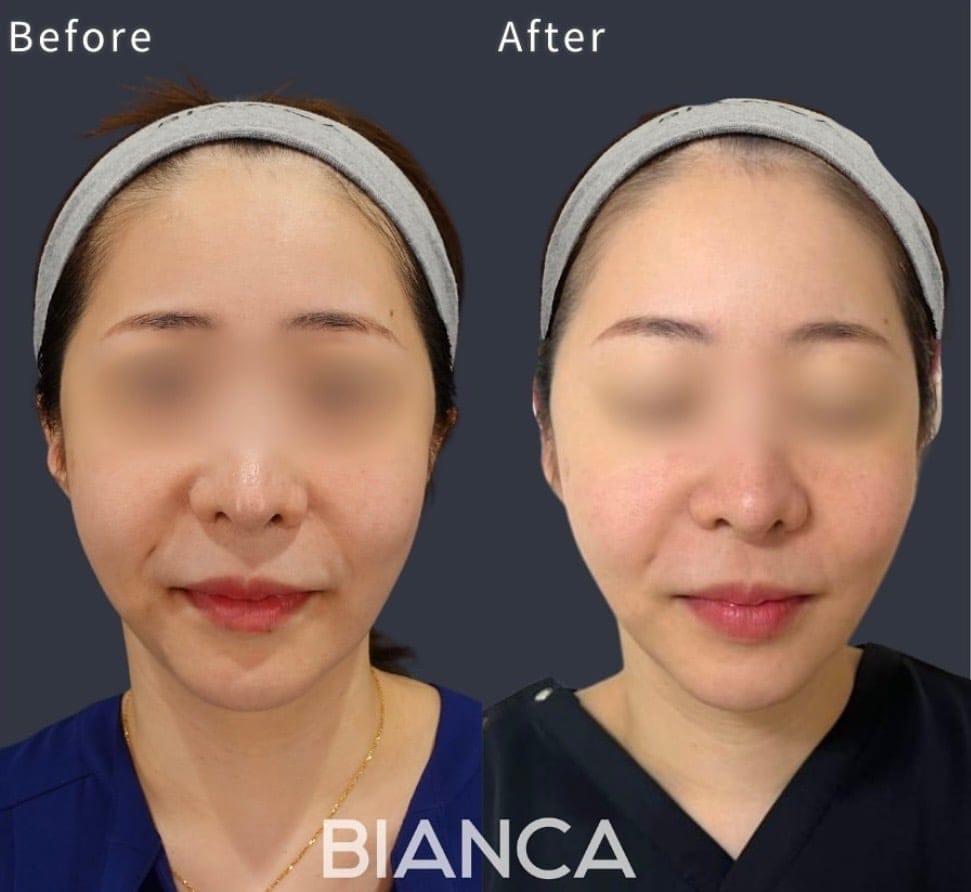 イベント前にボルニューマでたるみ治療を｜銀座・表参道にあるBIANCA CLINIC ビアンカクリニック｜美容外科・美容皮膚科・再生医療・美容婦人科・美容内科
