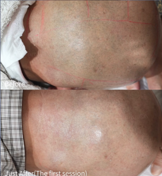 毎日剃る時代から、医療で整える時代へ｜ビアンカ銀座｜日本を代表する美容健康再生医療のクリニック