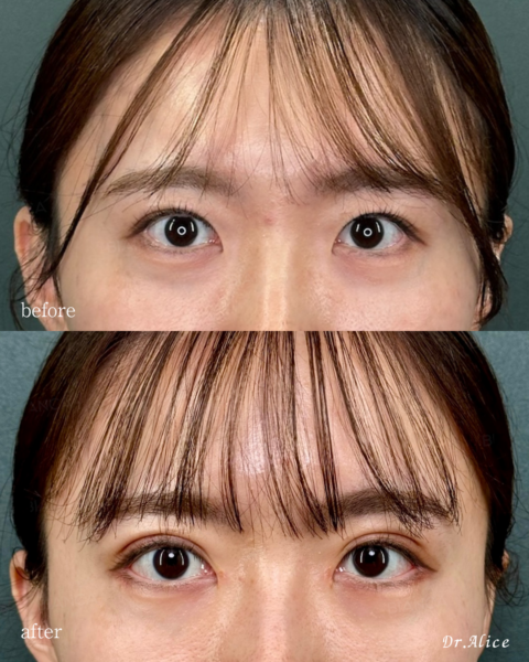 Alice’s EYE Method|顔全体からデザインする目元の拡大メソッド|銀座・表参道にあるBIANCA CLINIC ビアンカクリニック|美容外科・美容皮膚科・再生医療・美容婦人科・美容内科