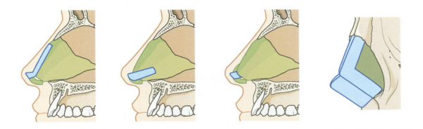 鼻中隔延長術とは？｜鼻先の「形」ではなく「土台」を再構築する手術｜銀座・表参道にあるBIANCA CLINIC ビアンカクリニック｜美容外科・美容皮膚科・再生医療・美容婦人科・美容内科