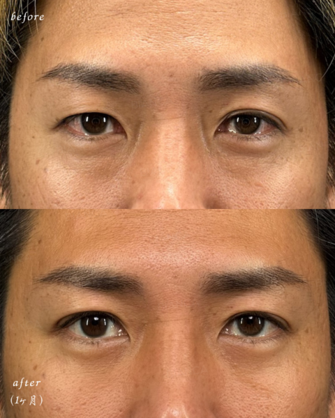 【男性症例】脱脂＋埋没法（自然癒着法）｜銀座・表参道にあるBIANCA CLINIC ビアンカクリニック｜美容外科・美容皮膚科・再生医療・美容婦人科・美容内科