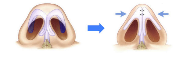 鼻尖形成＋鼻中隔延長はなぜセットで行うのか？｜銀座・表参道にあるBIANCA CLINIC ビアンカクリニック｜美容外科・美容皮膚科・再生医療・美容婦人科・美容内科