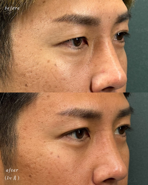 【男性症例】脱脂＋埋没法（自然癒着法）｜銀座・表参道にあるBIANCA CLINIC ビアンカクリニック｜美容外科・美容皮膚科・再生医療・美容婦人科・美容内科