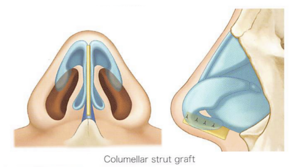 鼻中隔延長とコルメラストラットの違い｜「添える支え」と「構造の再構築」｜銀座・表参道にあるBIANCA CLINIC ビアンカクリニック｜美容外科・美容皮膚科・再生医療・美容婦人科・美容内科