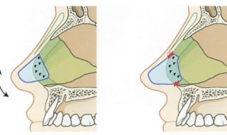 鼻中隔延長術とは？｜鼻先の「形」ではなく「土台」を再構築する手術｜ビアンカ銀座｜日本を代表する美容健康再生医療のクリニック