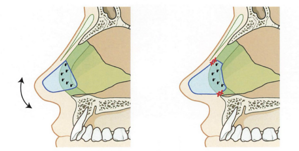 鼻中隔延長術とは？｜鼻先の「形」ではなく「土台」を再構築する手術｜銀座・表参道にあるBIANCA CLINIC ビアンカクリニック｜美容外科・美容皮膚科・再生医療・美容婦人科・美容内科