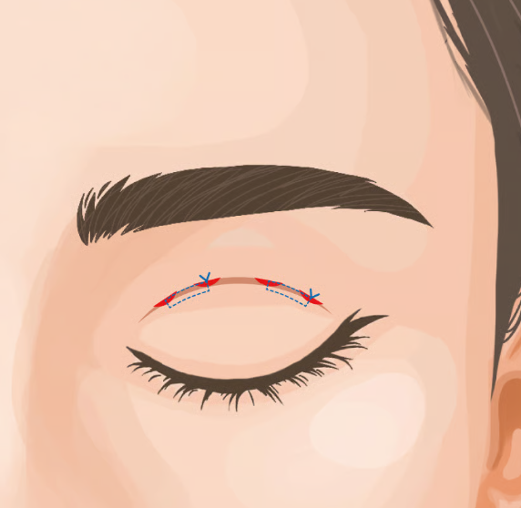 専門医が教える ― BIANCA式・埋没法の選び方と適応｜銀座・表参道にあるBIANCA CLINIC ビアンカクリニック｜美容外科・美容皮膚科・再生医療・美容婦人科・美容内科