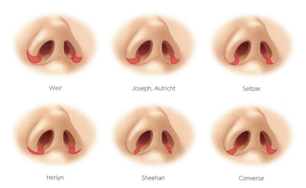 小鼻縮小（鼻翼縮小）の種類と切開位置の違い｜銀座・表参道にあるBIANCA CLINIC ビアンカクリニック｜美容外科・美容皮膚科・再生医療・美容婦人科・美容内科