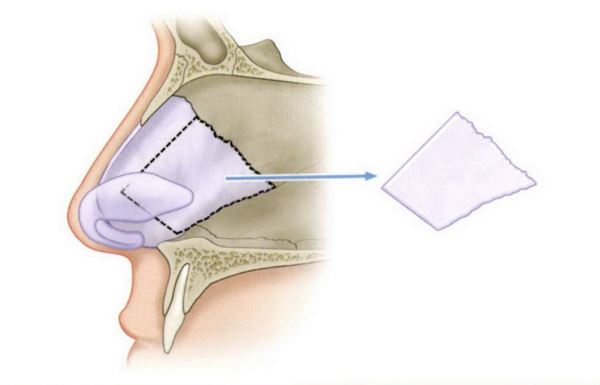 鼻中隔延長にどの軟骨を使う？｜鼻の骨組みを支える材料の選び方｜銀座・表参道にあるBIANCA CLINIC ビアンカクリニック｜美容外科・美容皮膚科・再生医療・美容婦人科・美容内科