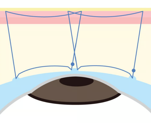 専門医が教える ― BIANCA式・埋没法の選び方と適応｜銀座・表参道にあるBIANCA CLINIC ビアンカクリニック｜美容外科・美容皮膚科・再生医療・美容婦人科・美容内科