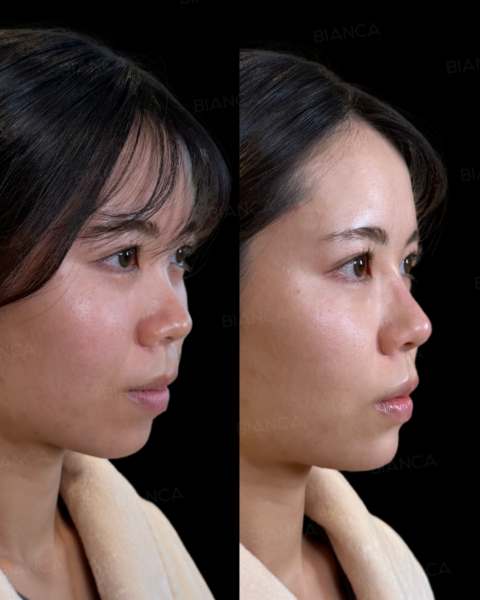 黄金比は不要？その人に合ったヒアルロン酸注入で横顔の美しさを引き出す。｜銀座・表参道にあるBIANCA CLINIC ビアンカクリニック｜美容外科・美容皮膚科・再生医療・美容婦人科・美容内科