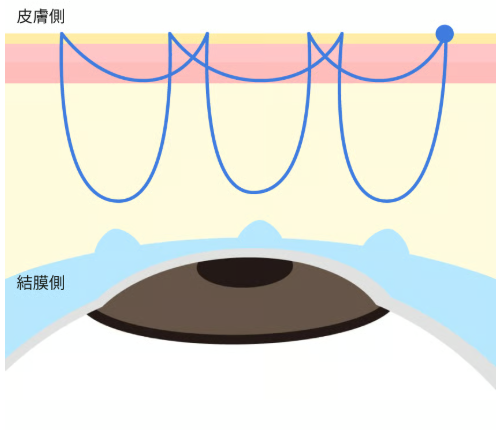 専門医が教える ― BIANCA式・埋没法の選び方と適応｜銀座・表参道にあるBIANCA CLINIC ビアンカクリニック｜美容外科・美容皮膚科・再生医療・美容婦人科・美容内科