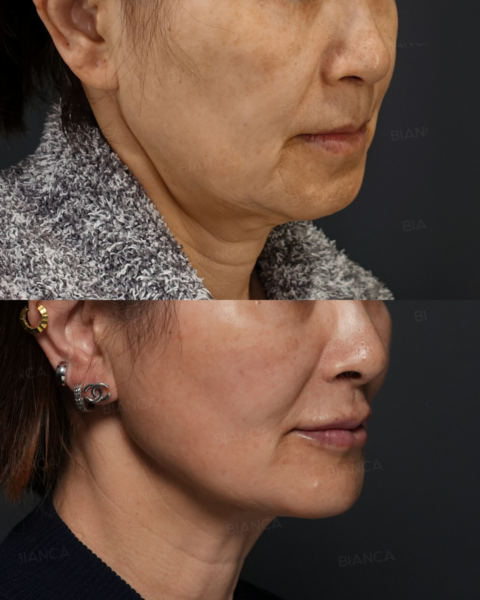 黄金比は不要？その人に合ったヒアルロン酸注入で横顔の美しさを引き出す。｜銀座・表参道にあるBIANCA CLINIC ビアンカクリニック｜美容外科・美容皮膚科・再生医療・美容婦人科・美容内科