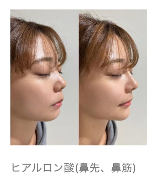 黄金比は不要？その人に合ったヒアルロン酸注入で横顔の美しさを引き出す。｜銀座・表参道にあるBIANCA CLINIC ビアンカクリニック｜美容外科・美容皮膚科・再生医療・美容婦人科・美容内科