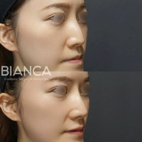 鼻整形、ヒアルロン酸と手術の違い｜目的別に考える治療の選択肢｜銀座・表参道にあるBIANCA CLINIC ビアンカクリニック｜美容外科・美容皮膚科・再生医療・美容婦人科・美容内科