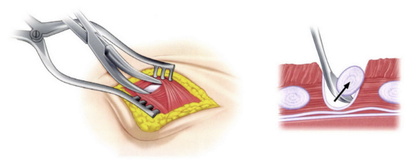 鼻中隔延長にどの軟骨を使う？｜鼻の骨組みを支える材料の選び方｜銀座・表参道にあるBIANCA CLINIC ビアンカクリニック｜美容外科・美容皮膚科・再生医療・美容婦人科・美容内科