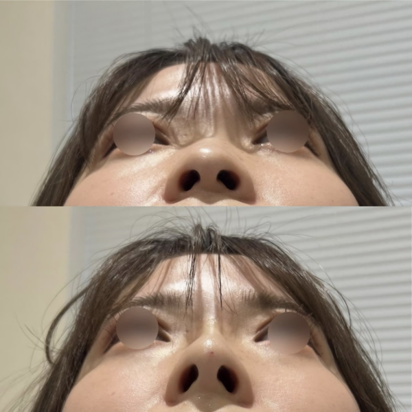 鼻整形、ヒアルロン酸と手術の違い｜目的別に考える治療の選択肢｜銀座・表参道にあるBIANCA CLINIC ビアンカクリニック｜美容外科・美容皮膚科・再生医療・美容婦人科・美容内科